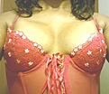 breast 2